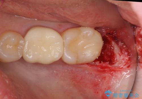 セラミックインレー 下の一番奥歯 歯ぐきの厚みを減らしてぴったりに入れます(ディスタルウェッジ+骨外科)の治療中
