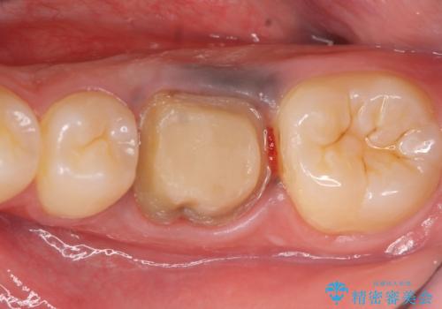 オールセラミッククラウン 治療途中の歯の再治療の治療中