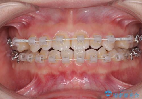矯正治療とインプラント治療を同時に 総合歯科診療の治療中