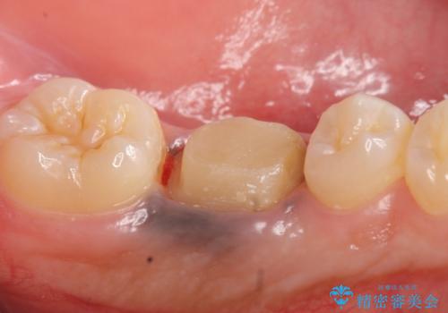 オールセラミッククラウン 治療途中の歯の再治療の治療中