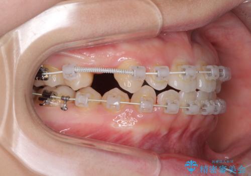 矯正治療とインプラント治療を同時に 総合歯科診療の治療中
