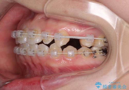 矯正治療とインプラント治療を同時に 総合歯科診療の治療中