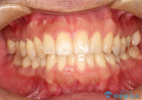 ワイヤーによる全体的ながたつきの矯正治療の症例 治療前