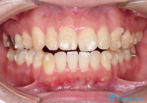 前歯でものが噛み切れない　インビザラインによるオープンバイトの治療の治療中