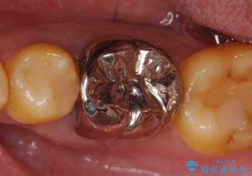 オールセラミッククラウン 他院にて抜歯と言われた歯の治療の治療前