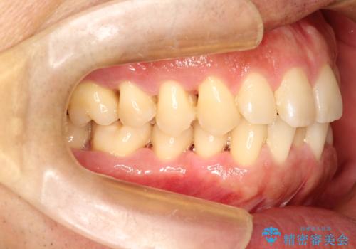 ワイヤーによる全体的ながたつきの矯正治療の治療前