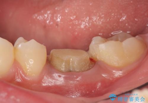 オールセラミッククラウン 治療途中の歯の再治療の治療中