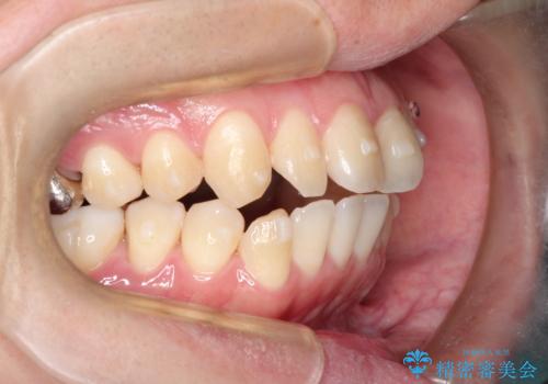 前歯でものが噛み切れない　インビザラインによるオープンバイトの治療の治療中
