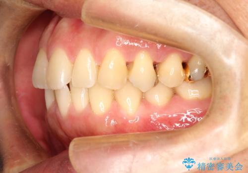 ワイヤーによる全体的ながたつきの矯正治療の治療前