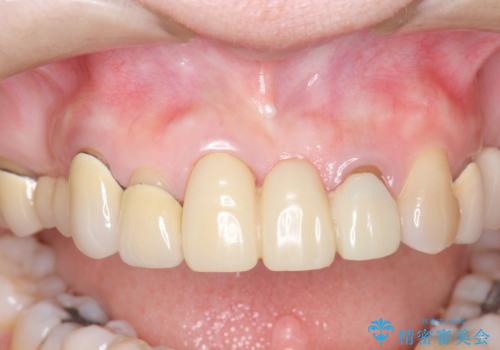 前歯ブリッジのやりかえの治療前