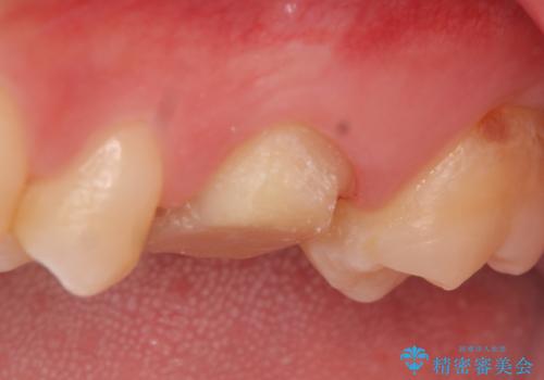 オールセラミッククラウン ズキズキ痛む歯の治療の治療中