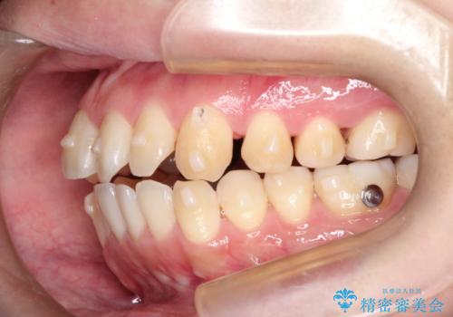 前歯でものが噛み切れない インビザラインによるオープンバイトの治療の治療中