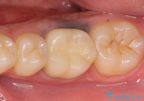 オールセラミッククラウン 治療途中の歯の再治療の治療後