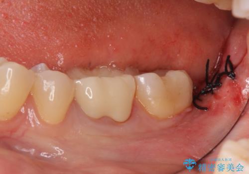 セラミックインレー 下の一番奥歯 歯ぐきの厚みを減らしてぴったりに入れます(ディスタルウェッジ+骨外科)の治療中