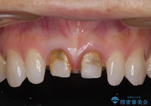 前歯をメタルフリーに　根管治療で不安を取り除いてからの治療中