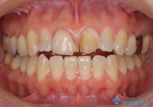 前歯のすきっぱ&奥歯の虫歯　セラミッククラウンで徹底的に治すの症例 治療前