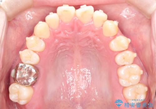 前歯でものが噛み切れない インビザラインによるオープンバイトの治療の治療中