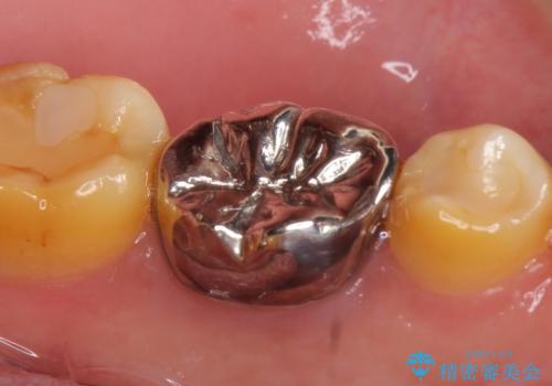 オールセラミッククラウン 他院にて抜歯と言われた歯の治療の治療前