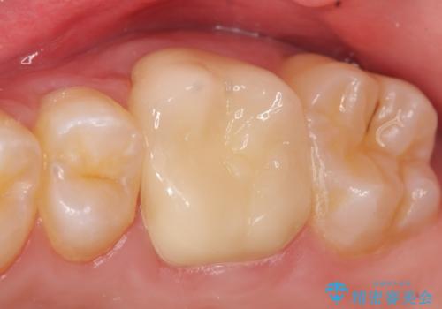 オールセラミッククラウン ズキズキ痛む歯の治療の治療後