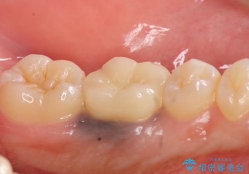 オールセラミッククラウン 治療途中の歯の再治療の治療後