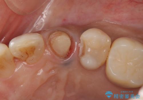 犬歯の変色　マウスピースで手軽にエクストリュージョン　歯ぐきの炎症をおさめますの治療前