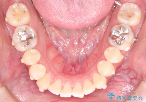 前歯でものが噛み切れない インビザラインによるオープンバイトの治療の治療中
