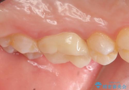 オールセラミッククラウン ズキズキ痛む歯の治療の治療後