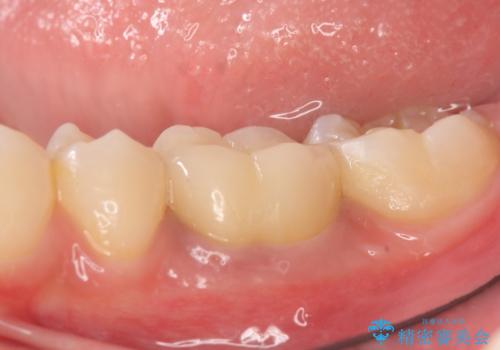 オールセラミッククラウン　治療途中の歯の再治療