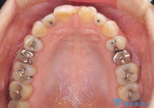 前歯のすきっぱ&奥歯の虫歯　セラミッククラウンで徹底的に治すの治療前