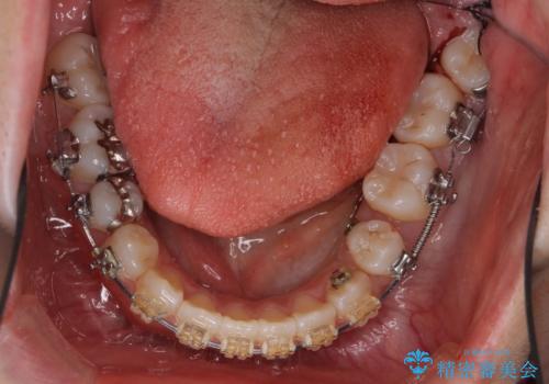 受け口 親知らずを取り込む矯正治療の治療中