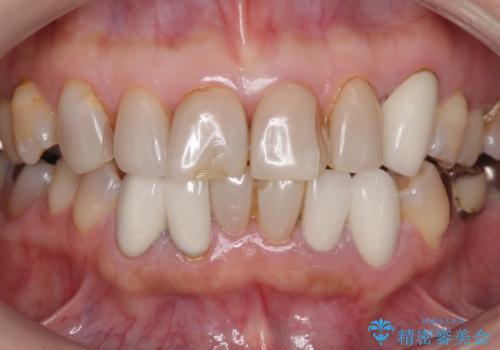 オールセラミッククラウン・セラミックインレー 口腔内全体の見た目の改善の治療前