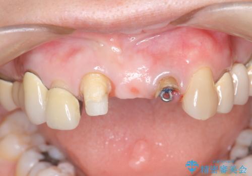 前歯ブリッジのやりかえの治療前