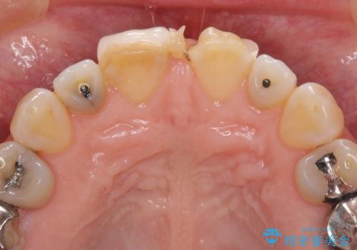 前歯のすきっぱ&奥歯の虫歯 セラミッククラウンで徹底的に治すの治療前