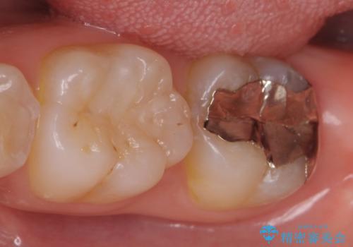 オールセラミッククラウン 奥歯の虫歯・深いポケットの除去の治療前