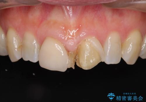 前歯のすきっぱ&奥歯の虫歯 セラミッククラウンで徹底的に治すの治療前