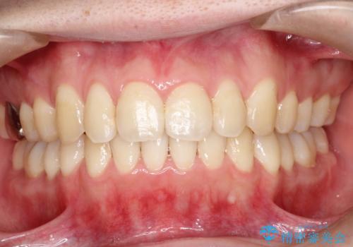 前歯でものが噛み切れない インビザラインによるオープンバイトの治療の治療後