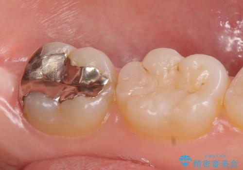 オールセラミッククラウン　奥歯の虫歯・深いポケットの除去の治療前