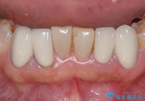 オールセラミッククラウン・セラミックインレー 口腔内全体の見た目の改善の治療前