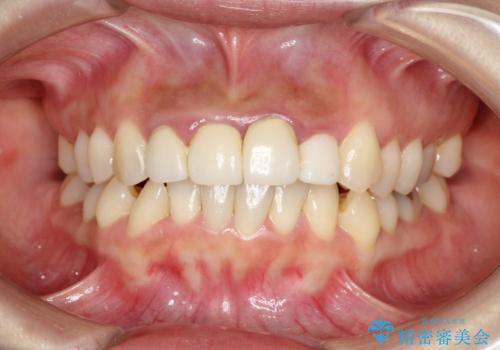 前歯のオールセラミック 腫れている歯肉が改善の治療前