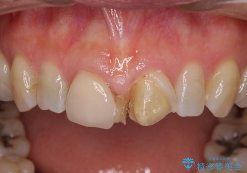 前歯のすきっぱ&奥歯の虫歯 セラミッククラウンで徹底的に治すの治療前
