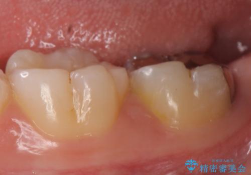 オールセラミッククラウン 奥歯の虫歯・深いポケットの除去の治療前