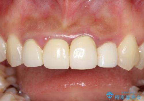 前歯のオールセラミック 腫れている歯肉が改善の治療前