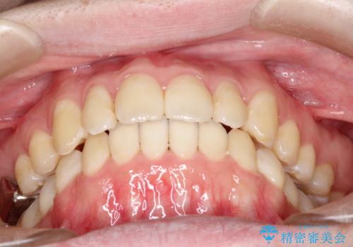 前歯でものが噛み切れない インビザラインによるオープンバイトの治療の治療後