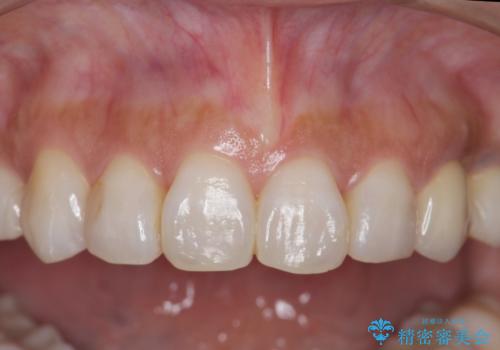 犬歯の変色 マウスピースで手軽にエクストリュージョン 歯ぐきの炎症をおさめますの治療後