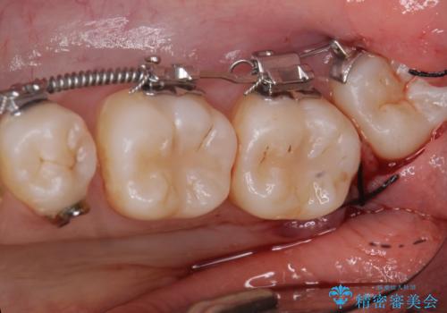 受け口 親知らずを取り込む矯正治療の治療中
