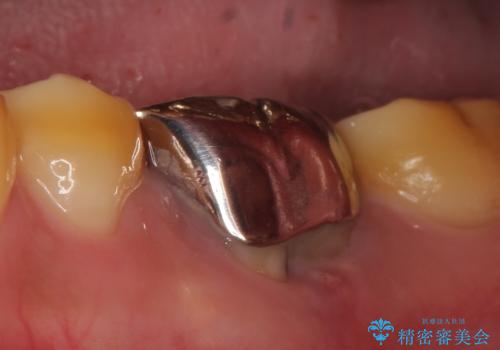 オールセラミッククラウン 他院にて抜歯と言われた歯の治療の症例 治療前