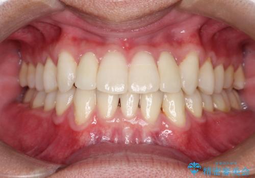 前歯のガタガタの矯正　下顎の前歯を1本抜歯してのインビザライン矯正の治療後