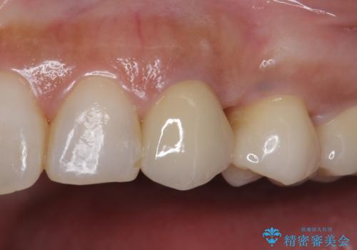 犬歯の変色 マウスピースで手軽にエクストリュージョン 歯ぐきの炎症をおさめますの症例 治療後