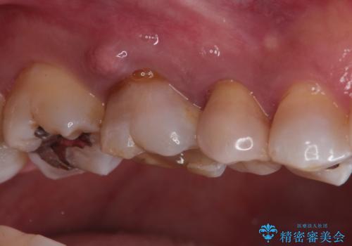 奥歯の根管治療~オールセラミッククラウンの治療前