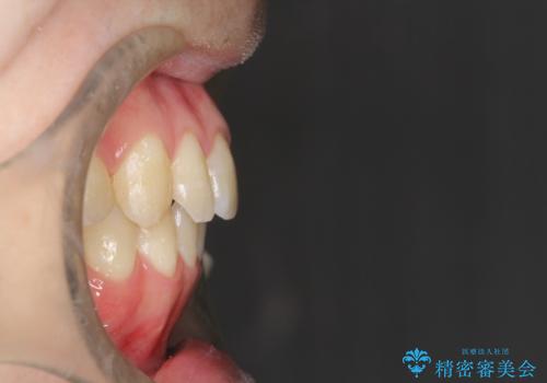 前歯でものが噛み切れない インビザラインによるオープンバイトの治療の治療後